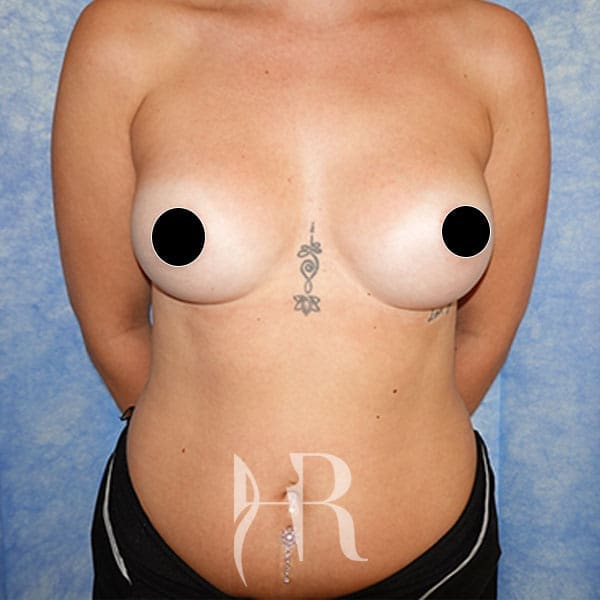 HR Plastic Surgery - Breast Enlargement patient after 6